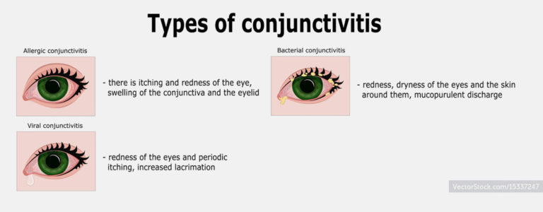 conjunctivitis-al-manal-eye-hospital